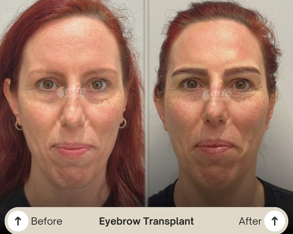 eyebrow transplantation result eyebrow transplantation result