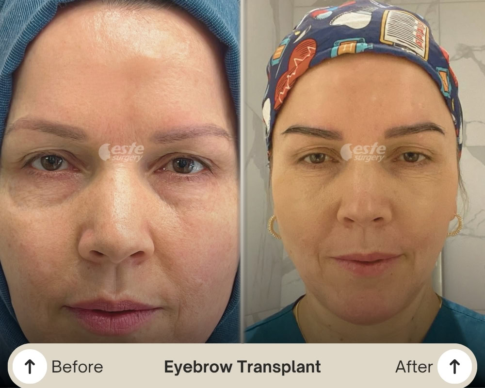 long manuel eyebrow transplant long manuel eyebrow transpant