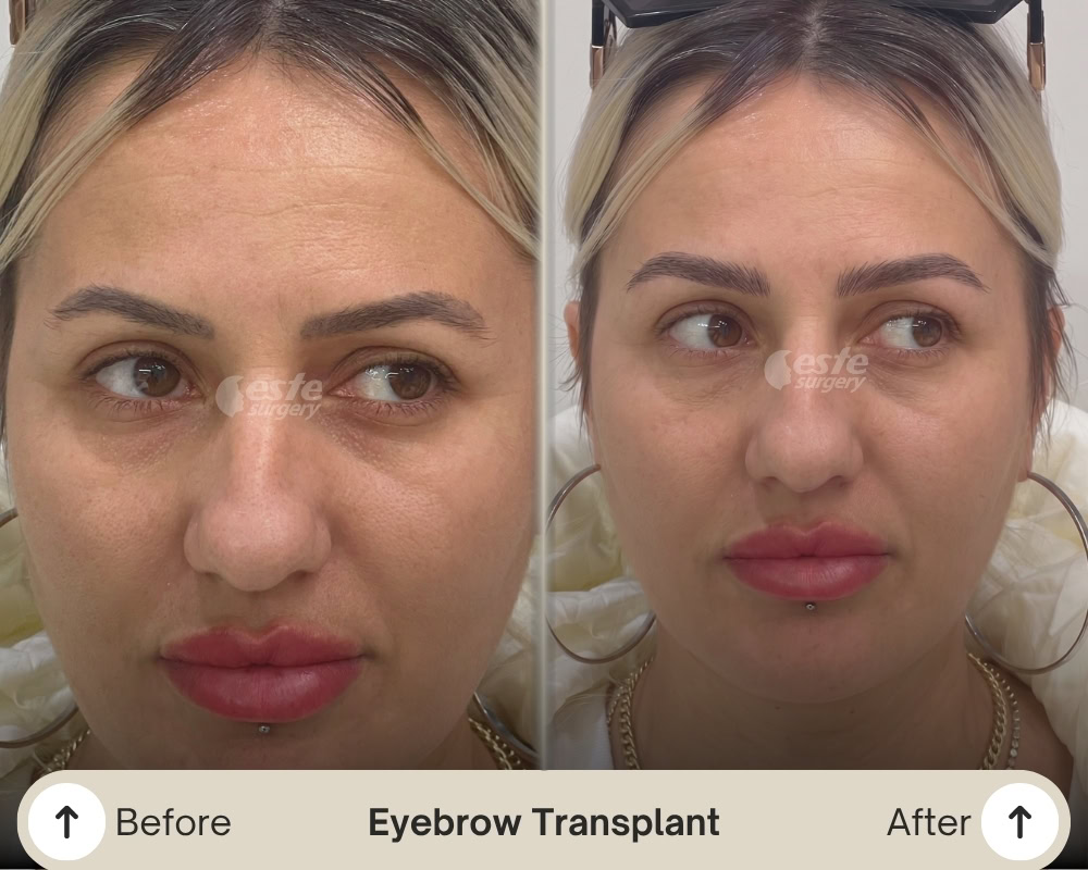 micro fue eyebrow transplant turkey micro fue eyebrow transplant turkey