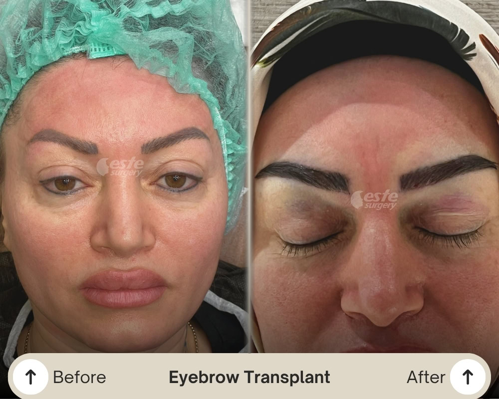 micro fue eyebrow transplant micro fue eyebrow transplant