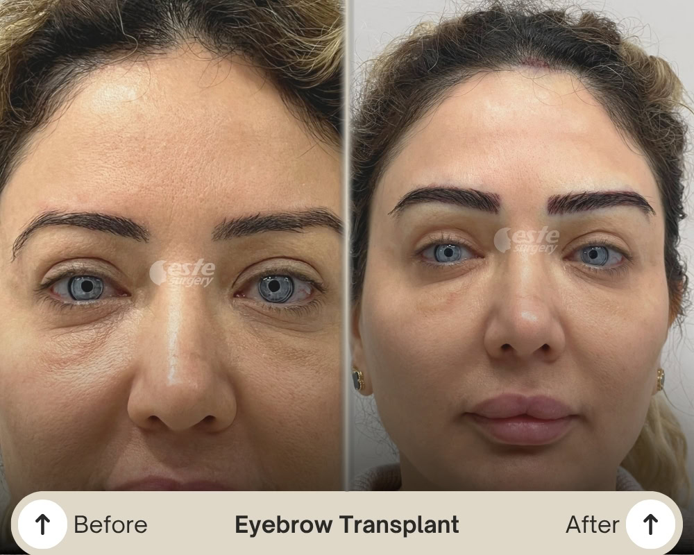 result of eyebrow t ransplant in turkey result of eyebrow transplant in Turkey